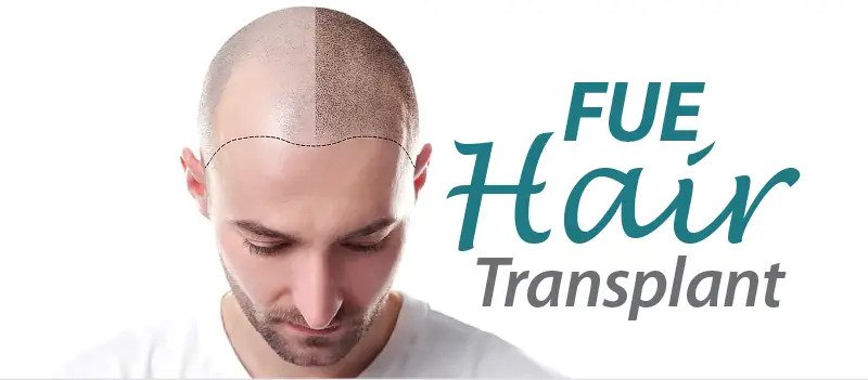 FUE hair transplant- Merits And Demerits of FUE Hair Transplant