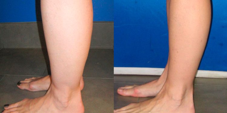 Best option to reduce Ankle Fat