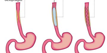 esophageal stent procedure