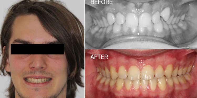 overbite before and after braces