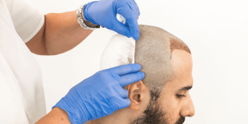 Is Hair Transplant Really Effective For Male Pattern Baldness