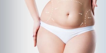 6 Signs You are a Suitable Candidate for Tummy Tuck