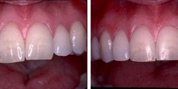 tooth reshaping and dental contouring