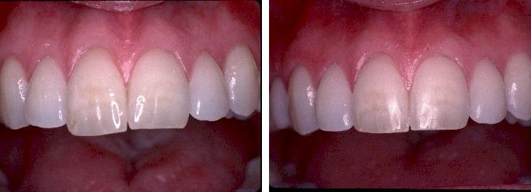 tooth reshaping and dental contouring