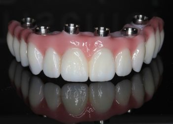 dental implant bridges