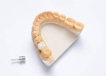ceramic crown molar on a dental implant. lower jaw plaster model