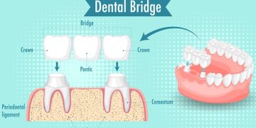 Dental Crowns And Dental Bridges